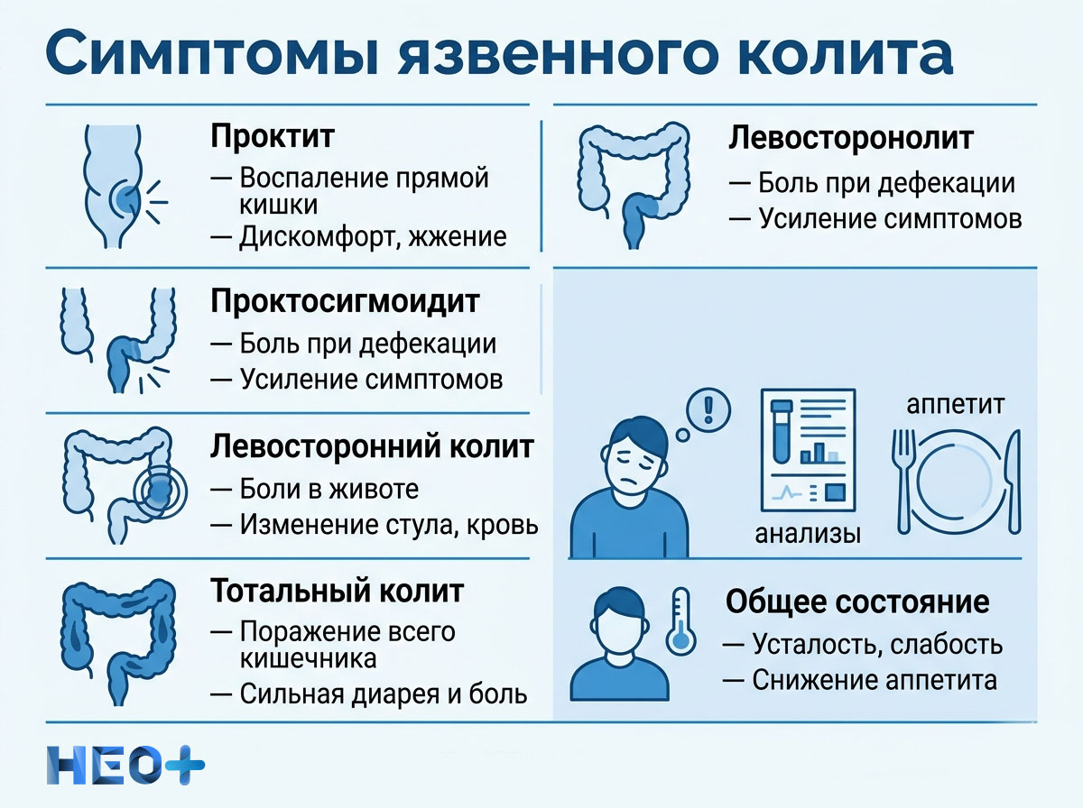Симптомы язвенного колита инфографика