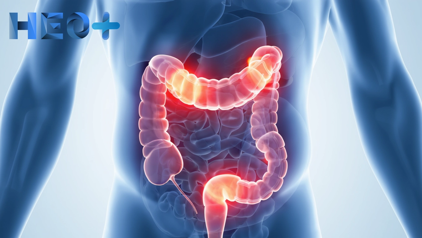 Язвенный колит